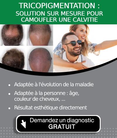 Homme heureux atteint de calvitie qu'il camoufle grâce à la tricopigmentation